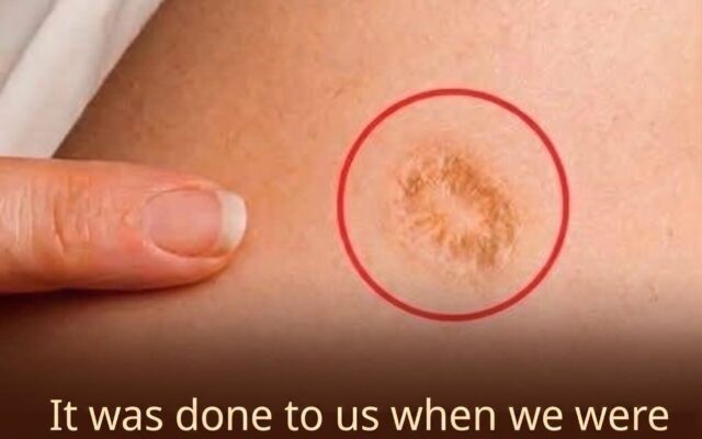 the small round scar on your upper arm has a remarkable story
